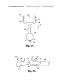 Instruments and methods for stabilization of bony structures diagram and image