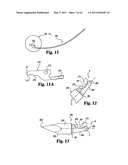 Instruments and methods for stabilization of bony structures diagram and image