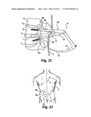 Instruments and methods for stabilization of bony structures diagram and image