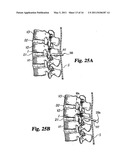 Instruments and methods for stabilization of bony structures diagram and image