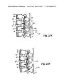 Instruments and methods for stabilization of bony structures diagram and image