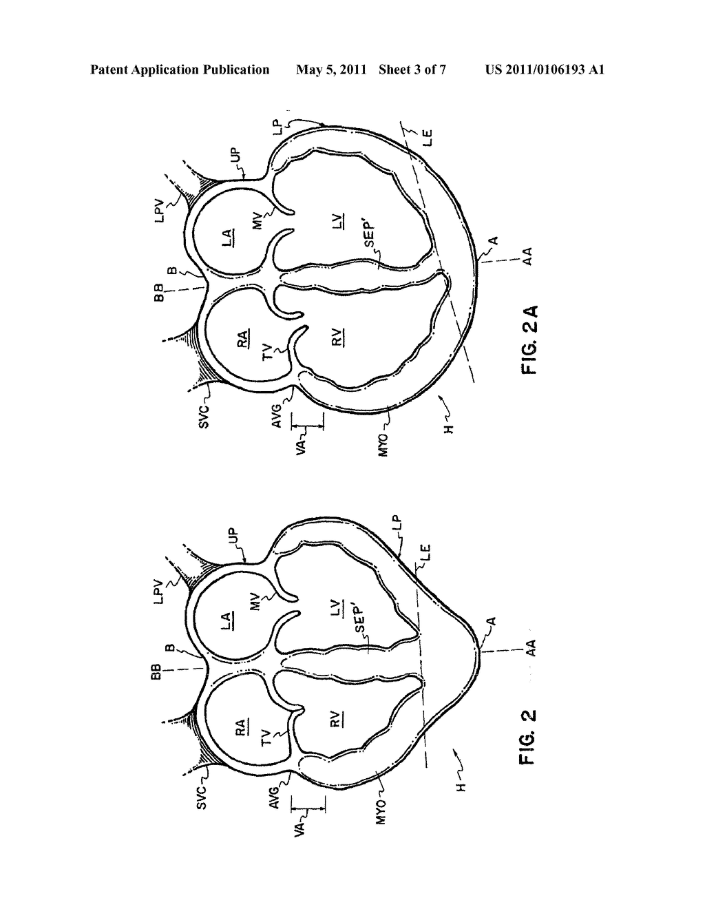 CARDIAC DISEASE TREATMENT AND DEVICE - diagram, schematic, and image 04