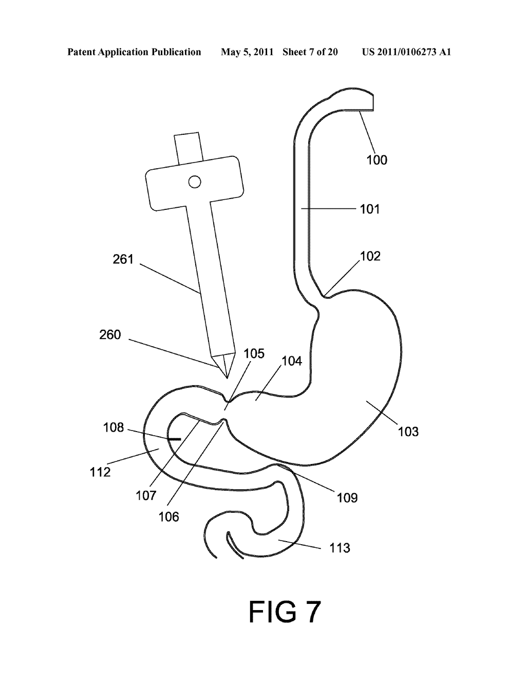 GASTROINTESTINAL PROSTHESES HAVING PARTIAL BYPASS CONFIGURATIONS - diagram, schematic, and image 08