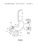 GASTROINTESTINAL PROSTHESES HAVING PARTIAL BYPASS CONFIGURATIONS diagram and image