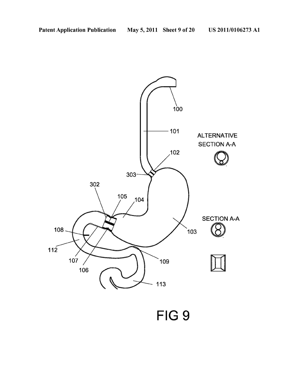 GASTROINTESTINAL PROSTHESES HAVING PARTIAL BYPASS CONFIGURATIONS - diagram, schematic, and image 10