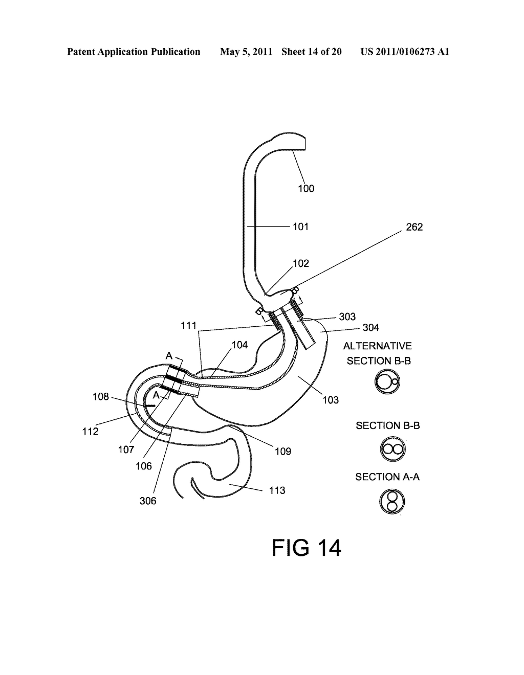 GASTROINTESTINAL PROSTHESES HAVING PARTIAL BYPASS CONFIGURATIONS - diagram, schematic, and image 15