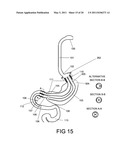 GASTROINTESTINAL PROSTHESES HAVING PARTIAL BYPASS CONFIGURATIONS diagram and image