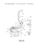 GASTROINTESTINAL PROSTHESES HAVING PARTIAL BYPASS CONFIGURATIONS diagram and image