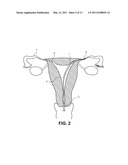 OCCLUSION IMPLANT diagram and image