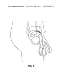 OCCLUSION IMPLANT diagram and image