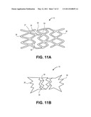 OCCLUSION IMPLANT diagram and image