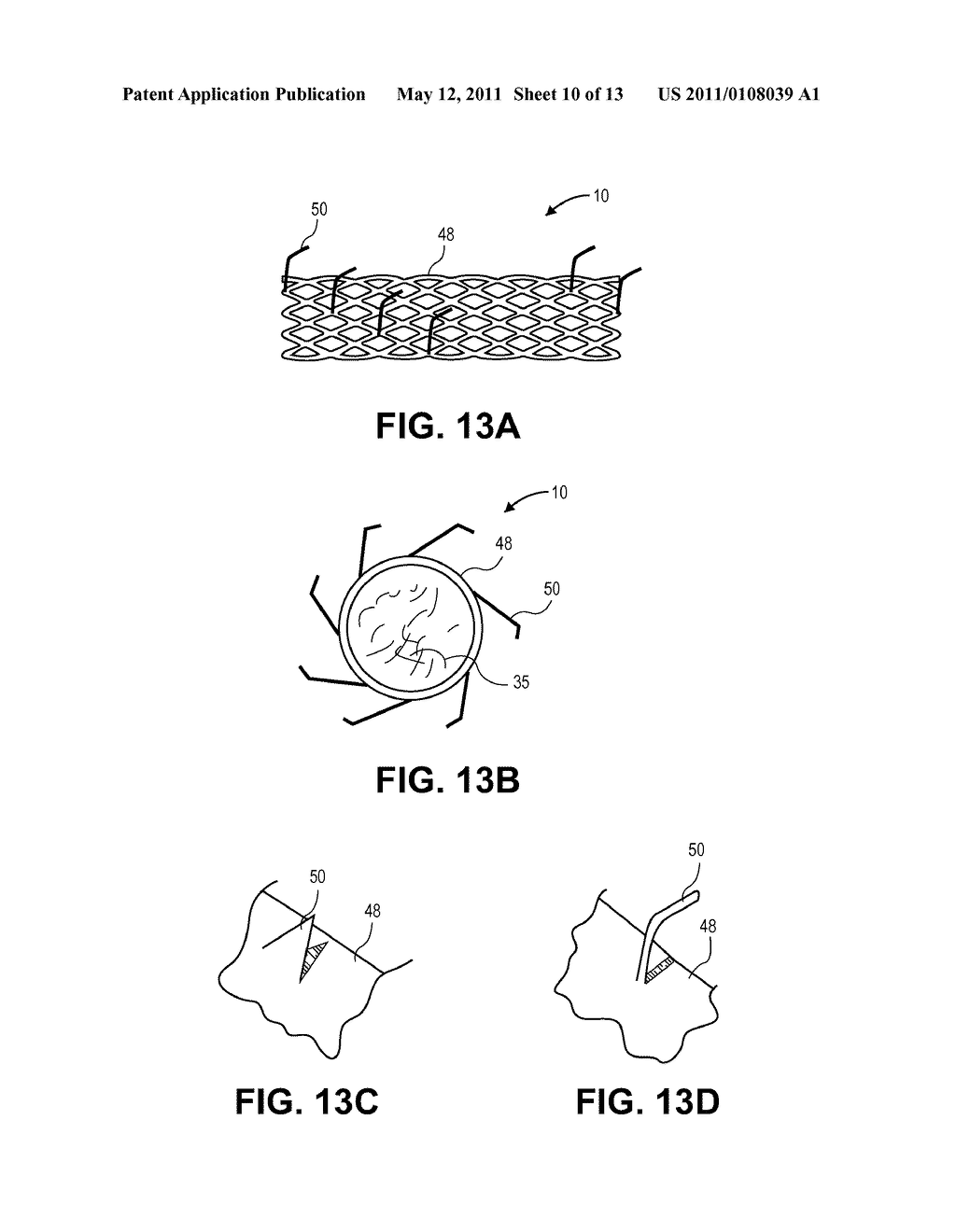 OCCLUSION IMPLANT - diagram, schematic, and image 11