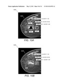 Selective Display Of Computer-Aided Detection Findings With Associated Breast X-Ray Mammogram and/or Tomosynthesis Image Information diagram and image