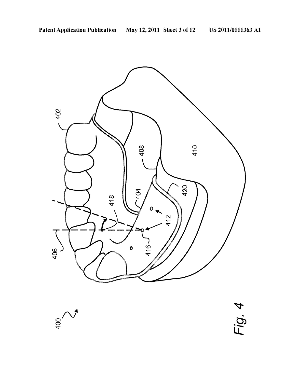 METHOD FOR REALIZING AN AXIAL TRAJECTORY IN A SURGICAL DRILLING PROCESS - diagram, schematic, and image 04