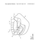 COMPUTER-AIDED DESIGN OF A DRILL GUIDE WITH A WINDOW diagram and image