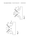 COMPUTER-AIDED DESIGN OF A DRILL GUIDE WITH A WINDOW diagram and image