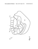 COMPUTER-AIDED DESIGN OF A DRILL GUIDE WITH A WINDOW diagram and image