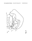 COMPUTER-AIDED DESIGN OF A DRILL GUIDE WITH A WINDOW diagram and image