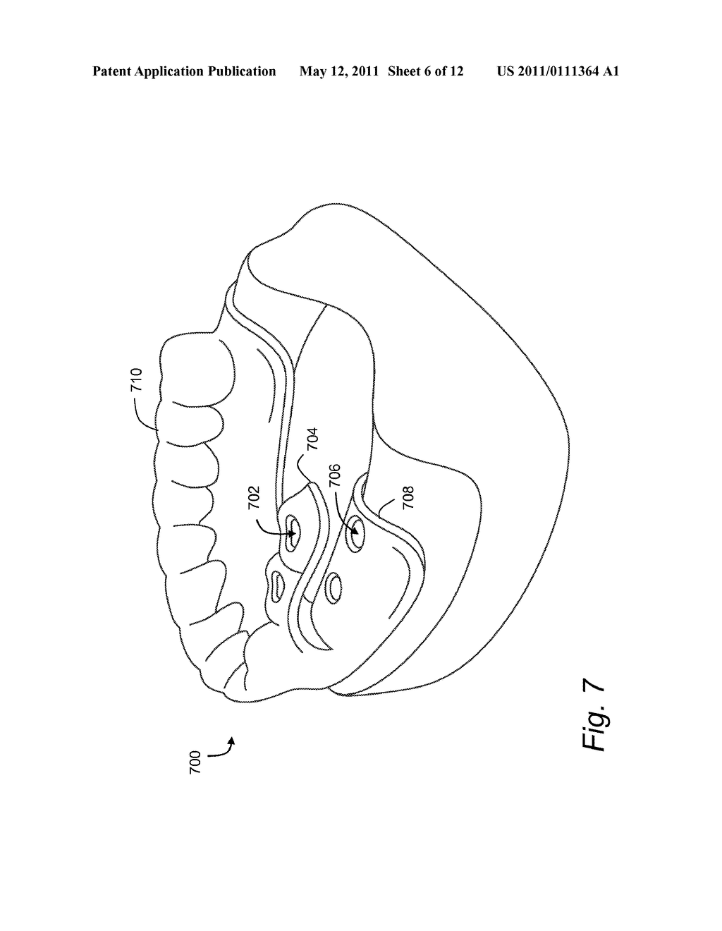 COMPUTER-AIDED DESIGN OF A DRILL GUIDE WITH A WINDOW - diagram, schematic, and image 07