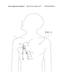 INTRAVENOUS CATHETER ANCHORING DEVICE diagram and image