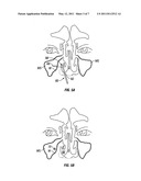 DEVICES AND METHODS FOR TREATING MAXILLARY SINUS DISEASE diagram and image