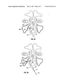 DEVICES AND METHODS FOR TREATING MAXILLARY SINUS DISEASE diagram and image