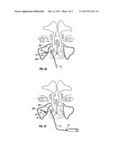 DEVICES AND METHODS FOR TREATING MAXILLARY SINUS DISEASE diagram and image