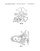 DEVICES AND METHODS FOR TREATING MAXILLARY SINUS DISEASE diagram and image