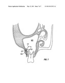 DEVICES AND METHODS FOR TREATING MAXILLARY SINUS DISEASE diagram and image