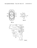 DEVICES AND METHODS FOR TREATING PAIN ASSOCIATED WITH TONSILLECTOMIES diagram and image