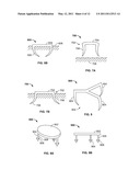 DEVICES AND METHODS FOR TREATING PAIN ASSOCIATED WITH TONSILLECTOMIES diagram and image