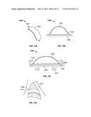 DEVICES AND METHODS FOR TREATING PAIN ASSOCIATED WITH TONSILLECTOMIES diagram and image