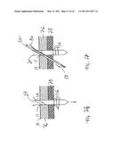 APPARATUS AND METHOD FOR LAPAROSCOPIC PORT SITE SUTURE diagram and image