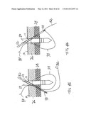 APPARATUS AND METHOD FOR LAPAROSCOPIC PORT SITE SUTURE diagram and image