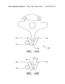 INTERSPINOUS PROCESS IMPLANT HAVING DEPLOYABLE WINGS AND METHOD OF IMPLANTATION diagram and image