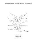 INTERSPINOUS PROCESS IMPLANT HAVING DEPLOYABLE WINGS AND METHOD OF IMPLANTATION diagram and image