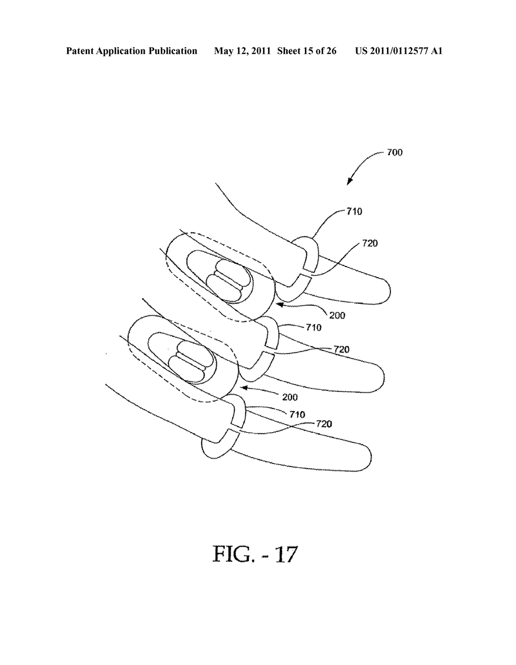 INTERSPINOUS PROCESS IMPLANT HAVING DEPLOYABLE WINGS AND METHOD OF IMPLANTATION - diagram, schematic, and image 16