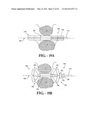 INTERSPINOUS PROCESS IMPLANT HAVING DEPLOYABLE WINGS AND METHOD OF IMPLANTATION diagram and image