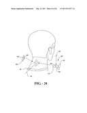 INTERSPINOUS PROCESS IMPLANT HAVING DEPLOYABLE WINGS AND METHOD OF IMPLANTATION diagram and image