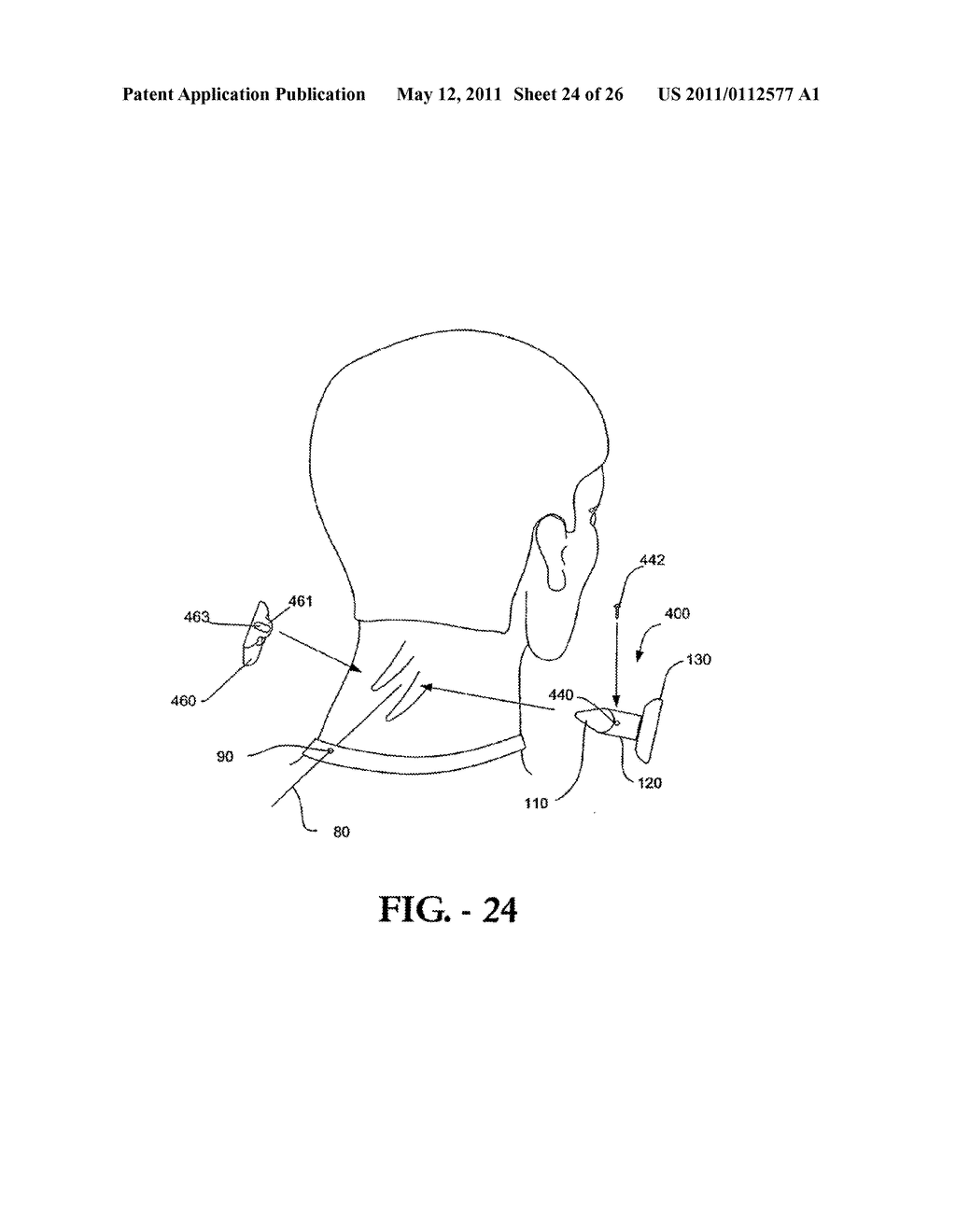 INTERSPINOUS PROCESS IMPLANT HAVING DEPLOYABLE WINGS AND METHOD OF IMPLANTATION - diagram, schematic, and image 25