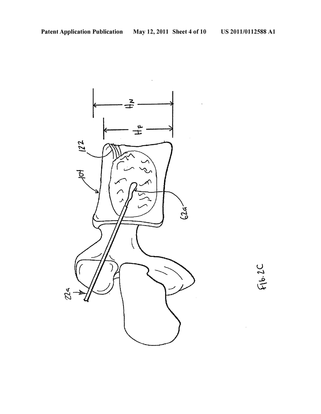 SYSTEMS AND METHODS FOR VERTEBRAL OR OTHER BONE STRUCTURE HEIGHT RESTORATION AND STABILIZATION - diagram, schematic, and image 05