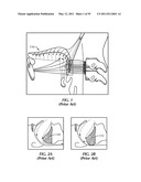 SYSTEM FOR STIMULATING A HYPOGLOSSAL NERVE FOR CONTROLLING THE POSITION OF A PATIENT S TONGUE diagram and image