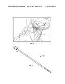 SYSTEM FOR STIMULATING A HYPOGLOSSAL NERVE FOR CONTROLLING THE POSITION OF A PATIENT S TONGUE diagram and image