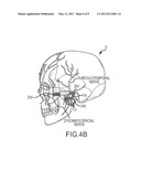 Extracranial implantable devices, systems and methods for the treatment of neuropsychiatric disorders diagram and image