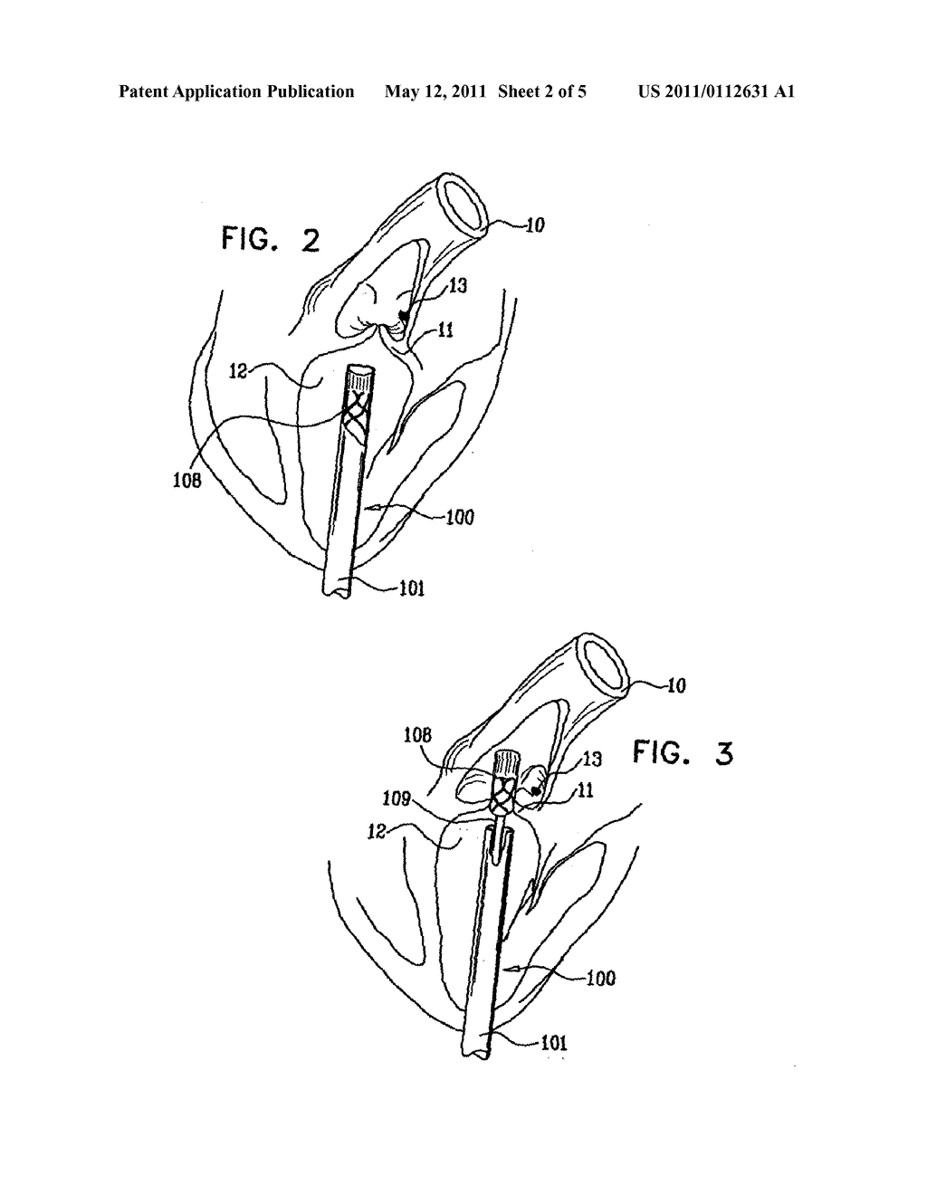 TRANSAPICAL DELIVERY SYSTEM WITH VENTRUCULO-ARTERIAL OVERLFOW BYPASS - diagram, schematic, and image 03