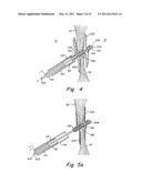 DELIVERY/RECOVERY SYSTEM FOR SEPTAL OCCLUDER diagram and image