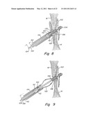 DELIVERY/RECOVERY SYSTEM FOR SEPTAL OCCLUDER diagram and image