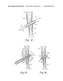 DELIVERY/RECOVERY SYSTEM FOR SEPTAL OCCLUDER diagram and image