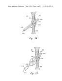 DELIVERY/RECOVERY SYSTEM FOR SEPTAL OCCLUDER diagram and image