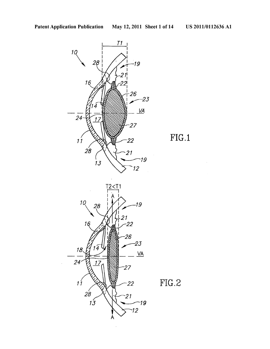 Accommodating Intraocular Lens (AIOL) Capsules - diagram, schematic, and image 02